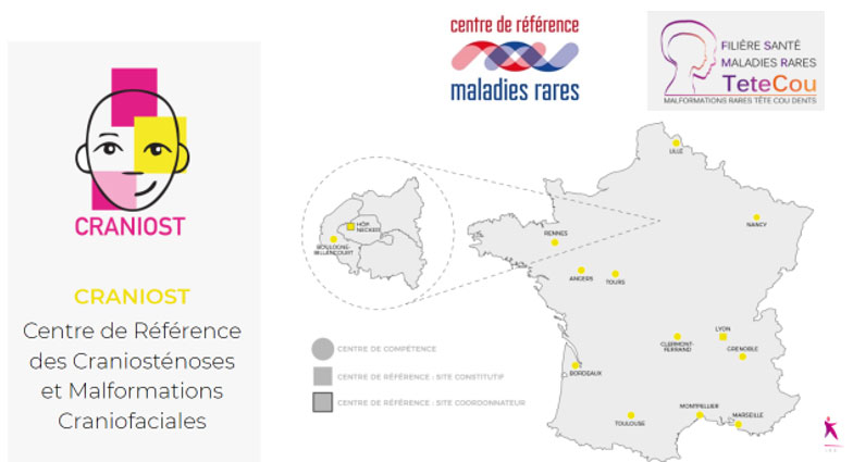 craniosténose chez l'enfant