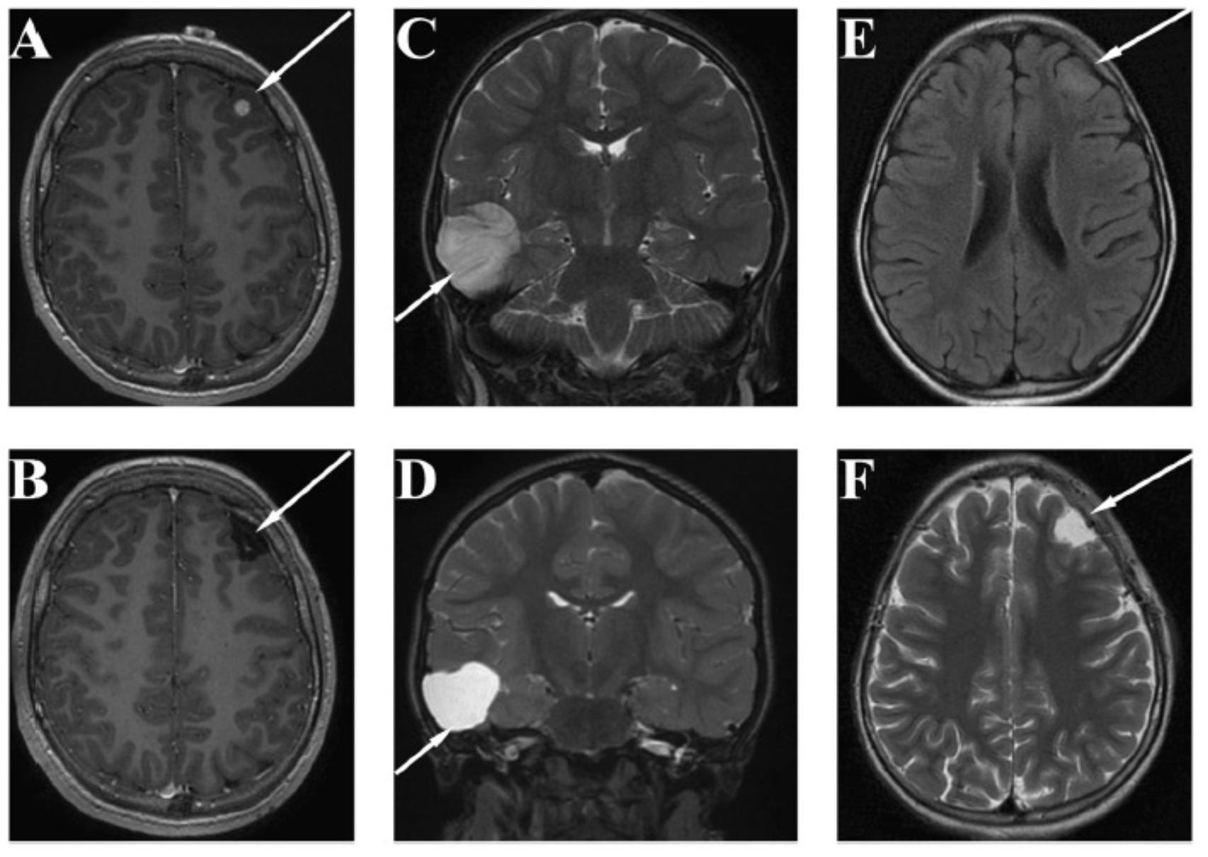 lesion epilepsie